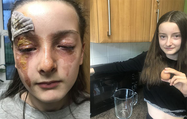 بعد وضعها في الميكروويف… بيضة شوهت ملامح وجه طفلة!